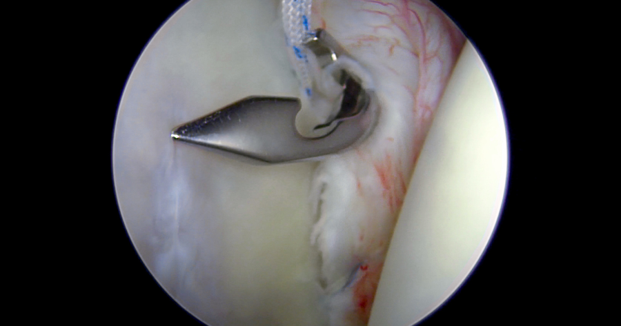 Arthroscopic Bankart Repair Surgeon