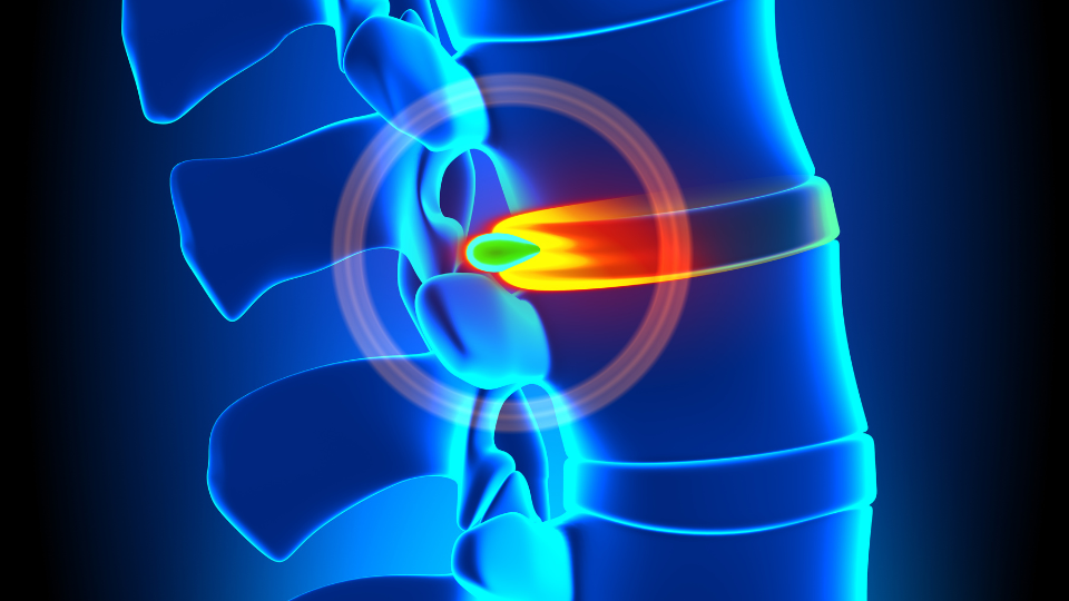 Cervical Herniated Disc 