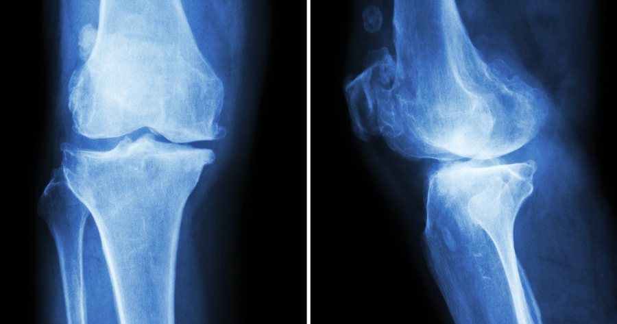 Osteoarthritis 