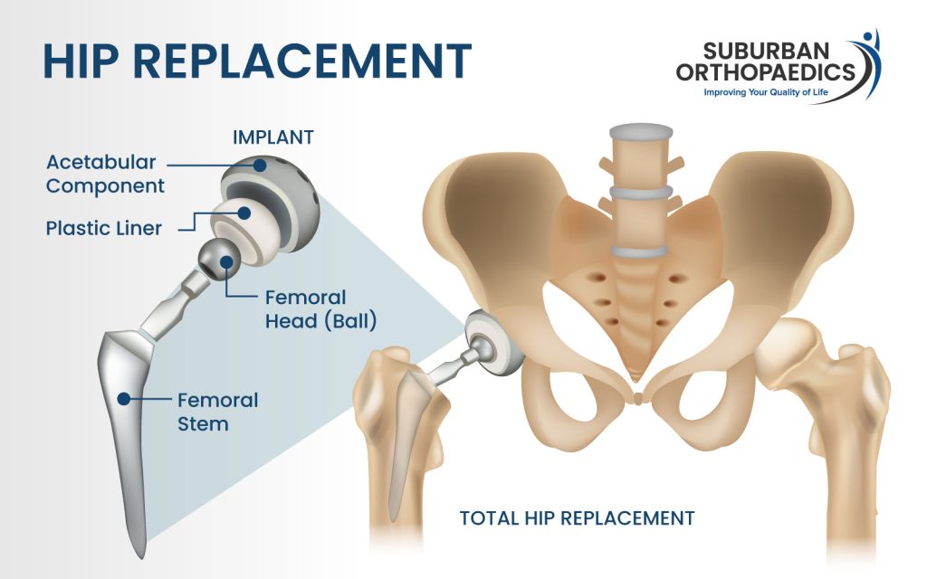 total hip replacement partial hip replacement diagram graphic
